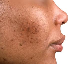 Boutons d'acné : soigner la peau à tendance acnéique