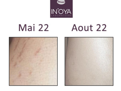 Hazra, 27 years old : Stretch marks on dark and mixed skin