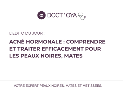 Acné hormonale : comprendre et traiter efficacement pour les peaux noires, mates