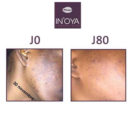 Aminata, 21 ans : Taches noires et boutons sur le visage