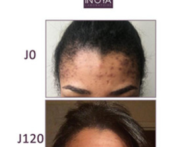 Amandine, 27 ans : Taches noires et boutons sur le visage
