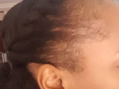 Afro Hair Loss: What to Do?