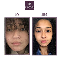 Louise, 25 years old: Black spots and pimples on the face