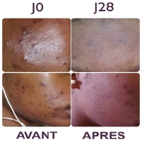 The IN’OYA range, a solution to spot and acne problems