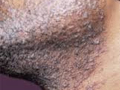 Comment éviter les boutons de rasage sur une peau noire 