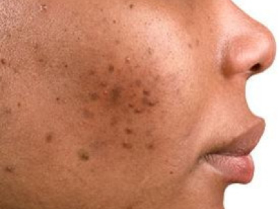 En finir avec les boutons d'acné sur la peau noire