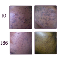 Angel, 36 years old - Reviews on the Anti-stain Serum, pimples and spots on the 