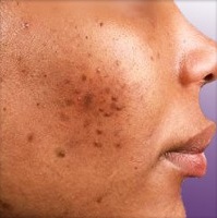 Acné & Peau Noire: Causes, Traitements, Conseils