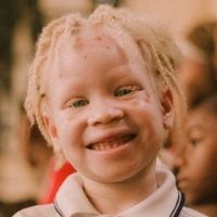 Understanding Albinism for Black Skin