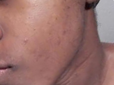 I AM IMPRESSED BY THE SIGNIFICANT IMPROVEMENT OF MY SPOTS