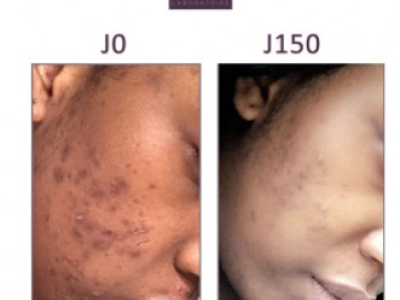 TOULÉMA, 21 YEARS OLD: BLACK SPOTS AND PIMPLES ON THE FACE