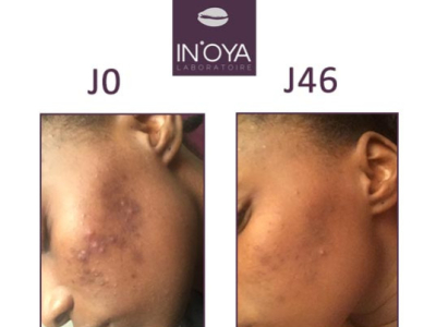 OUMOU, 21 YEARS OLD: BLACK SPOTS AND PIMPLES ON THE FACE