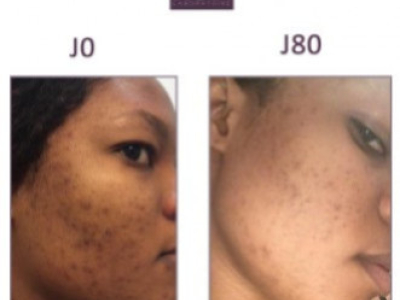 LYA, 26: TENACIOUS BLACK SPOTS ON THE FACE