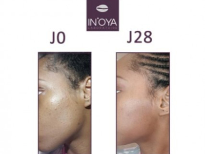 MAMY, 25 YEARS OLD : PIMPLES AFTER STOPPING CONTRACEPTION