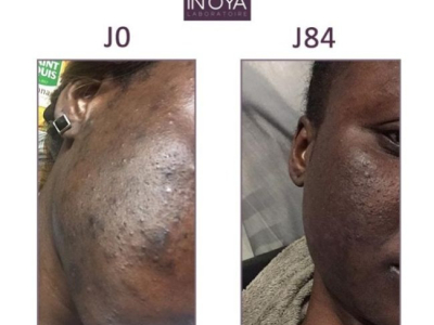 FATOU, 32 : HORMONAL SPOT AND PIMPLES