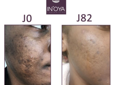 KAREN, 28 : DARK SPOT AND PIMPLES ON HER FACE