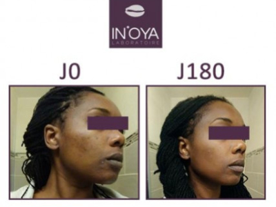 SONIA, 39 YEARS OLD : HORMONAL BLACK SPOTS ON THE FACE