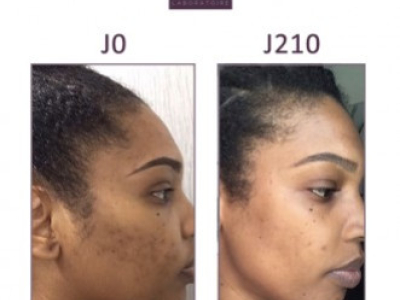 SYNDIE, 30 : DARK SPOT AND PIMPLES ON HER FACE