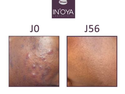 Myriane, Taches suite à des boutons hormonaux sur le visage